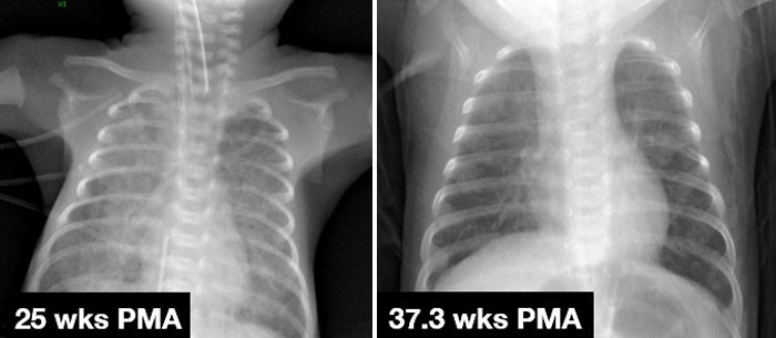 pneumostem